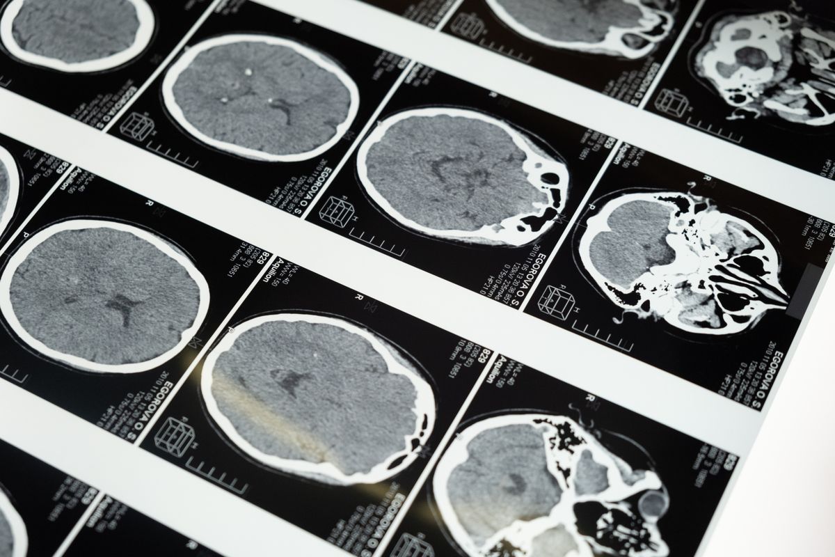 Brain MRI scans displayed on a clinic lightbox